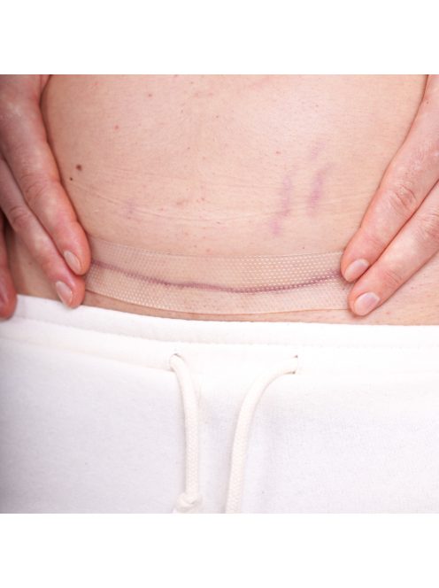 Momcare Császármetszés hegkezelő szilikontapasz 3db S-M